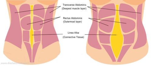 Diastasis Recti – Q&A Prevention And Solutions