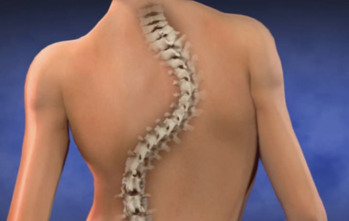 posture therapy correction singapore